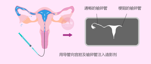 检查输卵管是否通畅，选择通液还是造影呢？