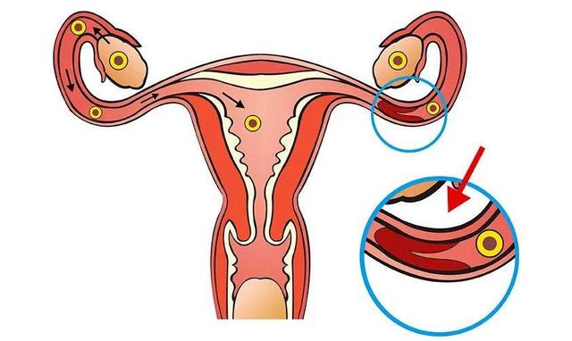 女性出现输卵管堵塞怎么办？及时治疗，预防宫外孕