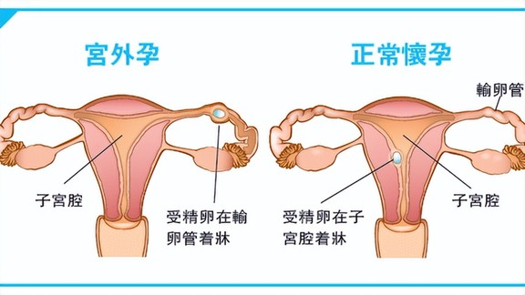 宫外孕是怎么一回事？很严重吗？