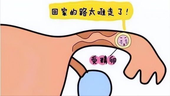 宫外孕是怎么一回事？很严重吗？