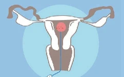 多囊卵巢综合征的表现有哪些？