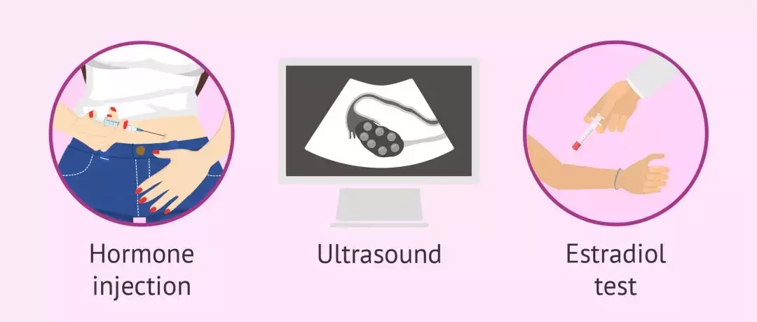 多囊卵巢综合征的药物和辅助生殖治疗