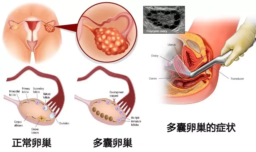 多囊卵巢综合征的药物和辅助生殖治疗