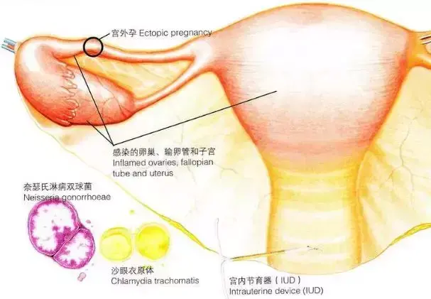 宫外孕还有“双胞胎”？这是怎么一回事？