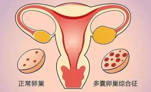 如何诊断多囊卵巢综合征？