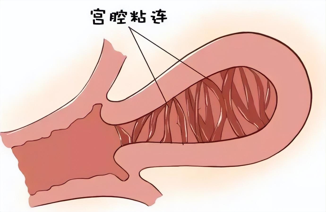 患有宫腔粘连影响试管吗？当然会，但治疗后也有希望