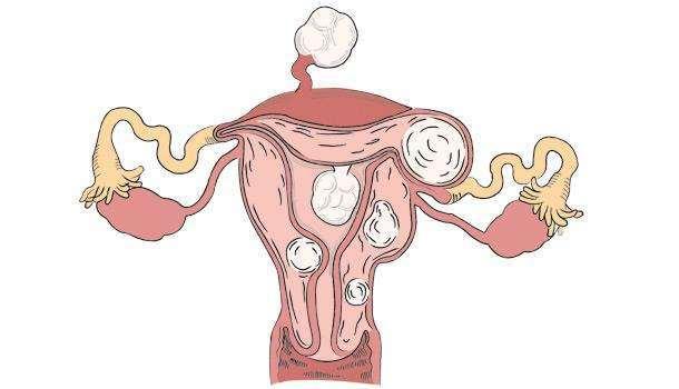4cm子宫肌瘤致不孕，通过试管婴儿助孕成功率有多高？