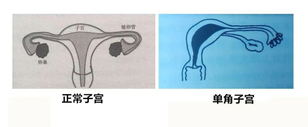 单角子宫怀孕图片