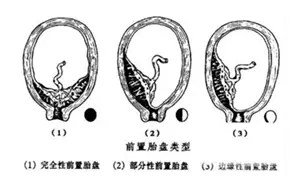 试管婴儿的产科风险是什么？