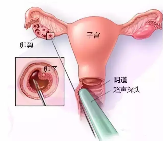 试管婴儿取卵的针有这么长长长的嘛？听说有人疼的打滚？