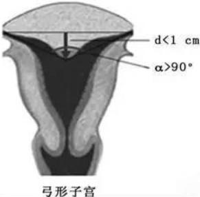 子宫畸形如何治疗？