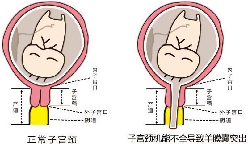 孕中期需警惕宫颈机能不全