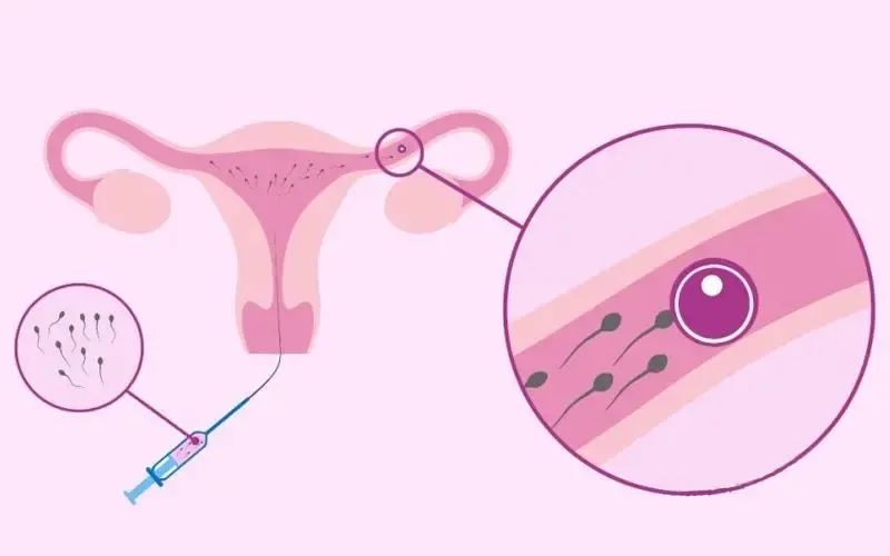 复发性流产患者适合选择辅助生殖技术助孕吗？