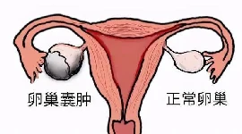 右侧卵巢囊肿蒂扭转是什么？为什么会出现这种疾病？