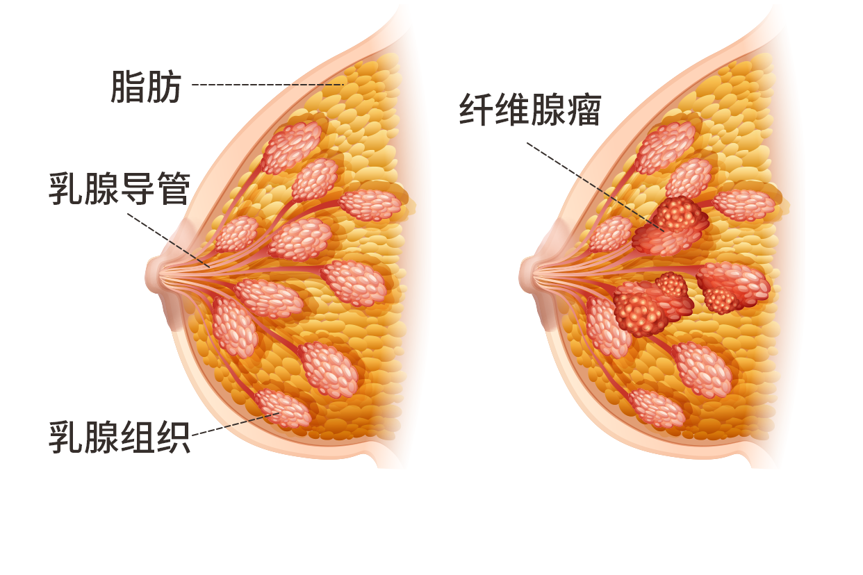 乳腺纤维瘤做试管有影响吗？会加重吗？