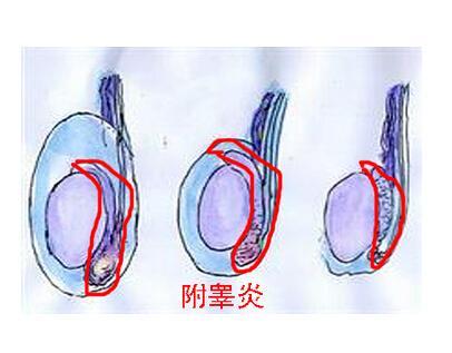附睾炎对男性的生育能力有很大影响，备孕的男性一定要注意预防