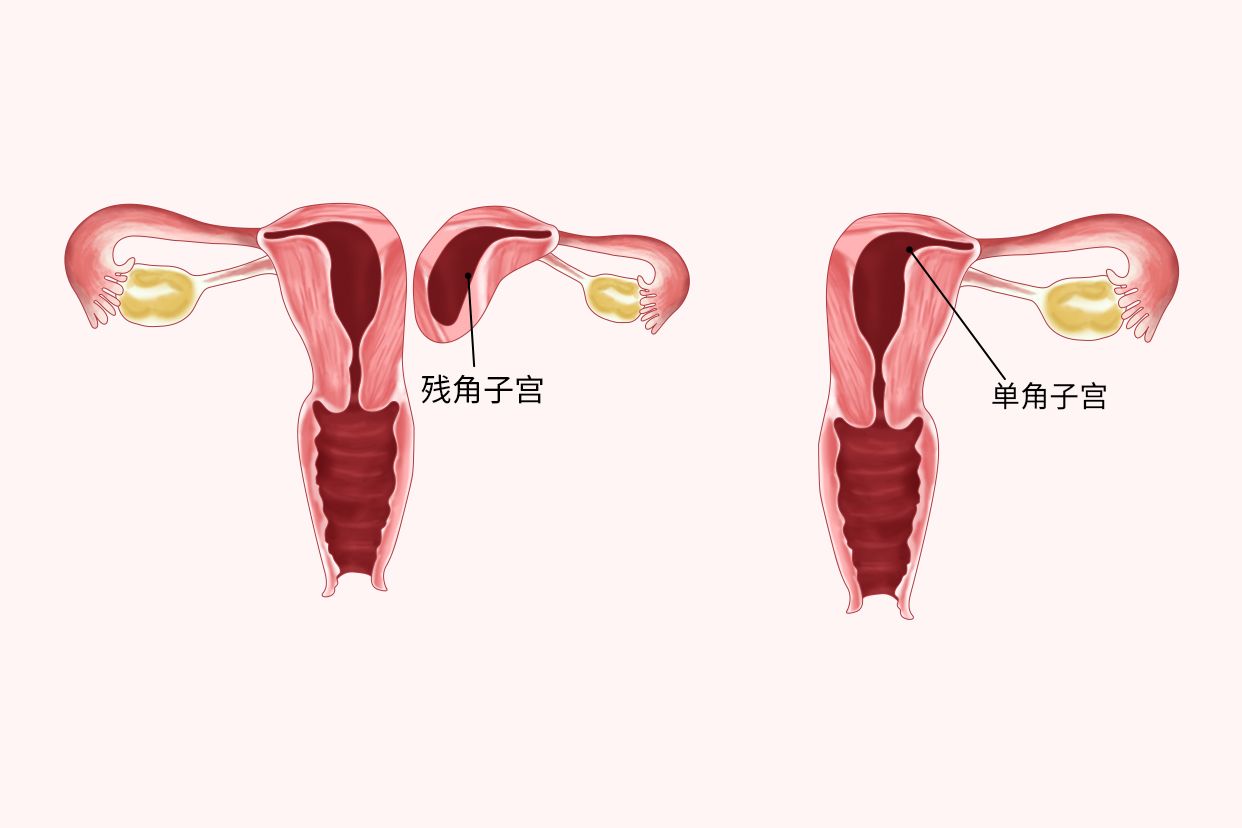 单角子宫合并残角子宫可以做试管吗，附解决措施及成功几率解读