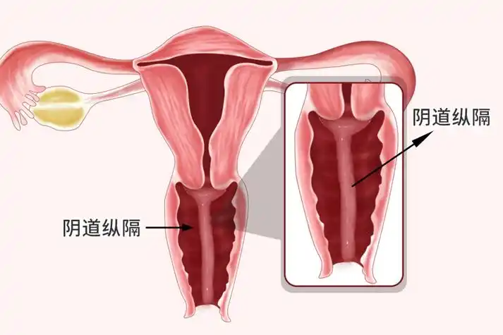 双阴道产生的原因是什么，双阴道可以自然受孕吗？