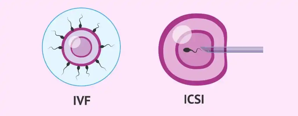 icsi是第几代试管婴儿?详解试管婴儿过程!